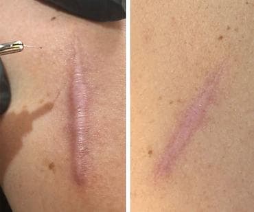 Yara izi korreksiyası xidməti - Fraksional mikroiynə və aparat lalafo.az -da Yara izi korreksiyası xidməti - Fraksional mikroiynə və aparat