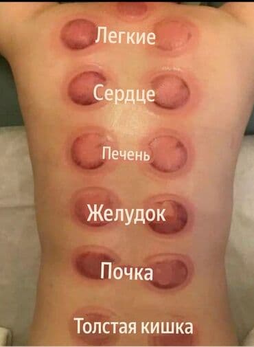 ищу сиделку в баку: 🩸 Массаж+Хиджама! 🩸 🚨 *Обслуживание на дому, в офисах и на рабочих — 3