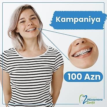 акция на установку брекетов: İnstaqram dr.zerif). Seçilən pasientlerə sonda kappa hədiyyə — 1