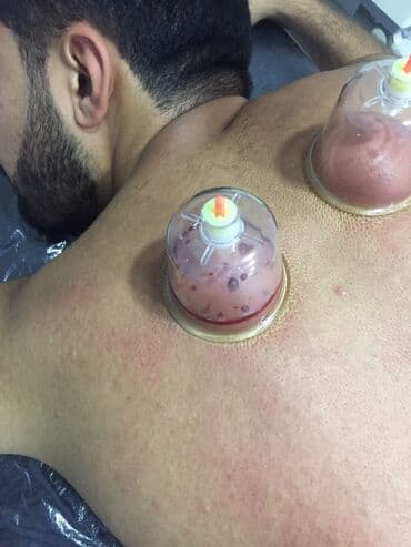 sari tukler ucun lazer: Bəylər üçün = Hicama Və Zəli ✅Zəlinin Faydaları(Hirudoterapiya) — 7