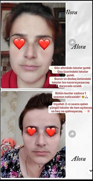 gen: GÜNƏŞ ÇİLİ VƏ LƏKƏLƏR ÜÇÜN LOSYON + SPF SETİ ☀️ Günəş ləkələri, çillər — 3