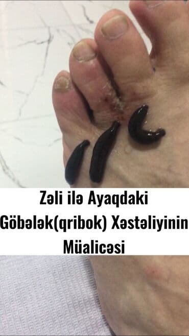 ağ dırnaq modelleri: Hicamanın Faydaları✅ *Qan dövranın pozulması *Qanın təmizlənməsi — 7