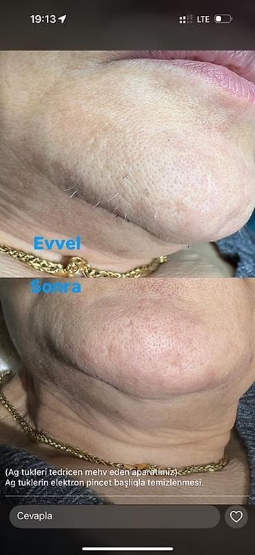 соевый воск: Xidmət: Ağ tüklərin elektron pincet başlıqla təmizlənməsi və tədricən — 1