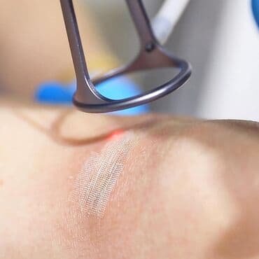 estetik: 10600 lazer cilalanması vasitəsilə müxtəlif kosmetoloji və estetik — 2