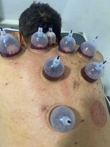 ağ dırnaq modelleri: Hicamanın Faydaları✅ *Qan dövranın pozulması *Qanın təmizlənməsi — 18