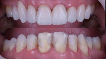 акция на установку брекетов: Stomatoloji xidmetler tam steril ve muasir. dislerin plomblanmasi — 9