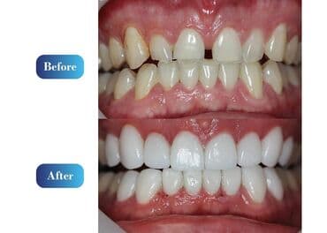акция на установку брекетов: Stomatoloji xidmetler tam steril ve muasir. dislerin plomblanmasi — 21