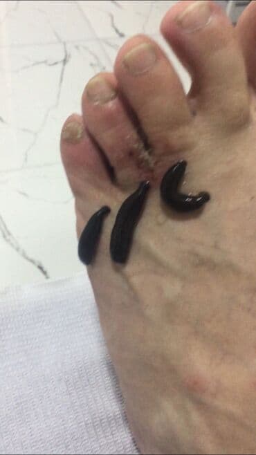 sari tukler ucun lazer: Bəylər üçün = Hicama Və Zəli ✅Zəlinin Faydaları(Hirudoterapiya) — 12