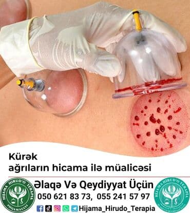 bioloji yaşam sağlamlıq mərkəzi: 📌hi̇cama nədi̇r❓ 🔷️qanalma ilə müalicə üsulu olaraq. Xəstəliklərə — 3