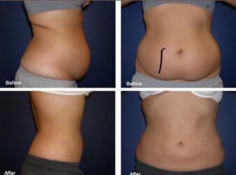 dermapen qiymeti: Plastik estetik hər yüksək səviyyə uyğun qiymət!!!Burdan mesaj — 7