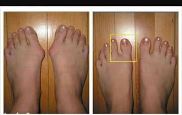 padaqra ucun silikon: Padaqranı mualice eden ve agrinin qarşisini alan fiksator. Silikon — 6