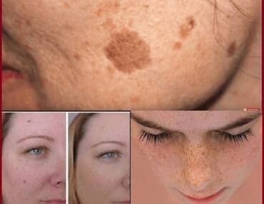 крем барои сафед кардани кус: Крем для лица, Для склонной к акне кожи, 40 мл, Платная доставка — 2