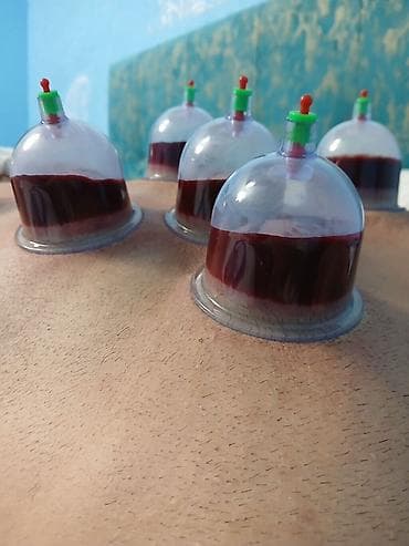 Хиджама, пиявки: Hicama (qan çıxarma) xidməti - Steril, birdəfəlik vakuum bankalar və — 1