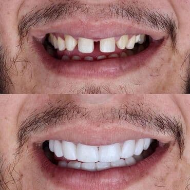 акция на установку брекетов: Stomatoloji xidmetler tam steril ve muasir. dislerin plomblanmasi — 11