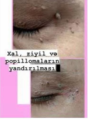 Обучение, курсы: Xal, ziyil və papillomaların yandırılması xidməti - Bədəndə və üzdə — 2