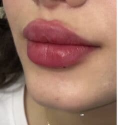 dermapen qiymeti: Plastik estetik hər yüksək səviyyə uyğun qiymət!!!Burdan mesaj — 5