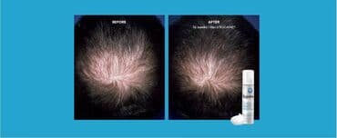 королевский боб для похудения 36 капсул: Спрей для волос, От выпадения волос, Новый — 13