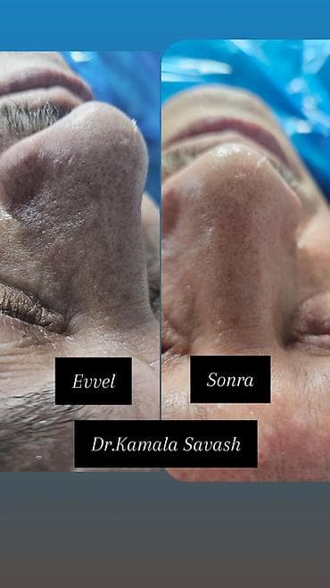 🌿 Çoxmərhələli Dərin Üz Təmizlənməsi Peşəkar kosmetoloq tərəfindən