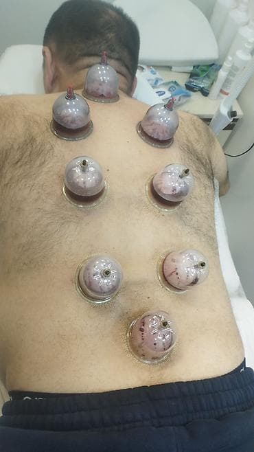 ingilis dili qrammatika: Xidmət: Hicama (qanın vakuumla çıxarılması) və banka terapiyası — 1