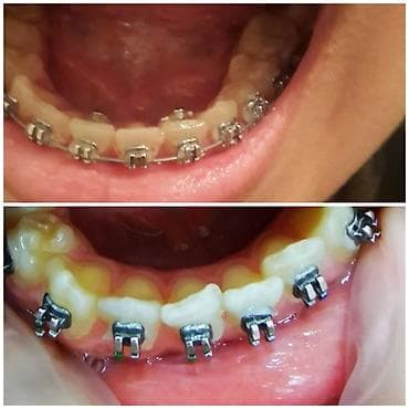 акция на установку брекетов: İnstaqram dr.zerif). Seçilən pasientlerə sonda kappa hədiyyə — 6