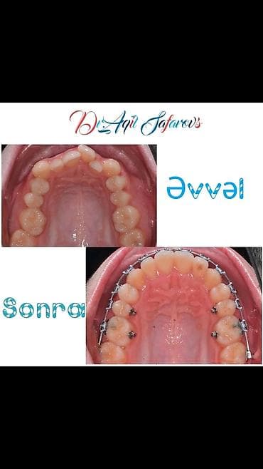 Ремонт техники: Ortodontik müalicə və gülüşün tam bərpası xidməti Təsvir: - Dişlərin — 6