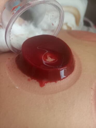 ремонт домашних телефонов на дому: Hicama proseduru üçün istifadə olunan tibbi bankalar. Bu bankalar — 6