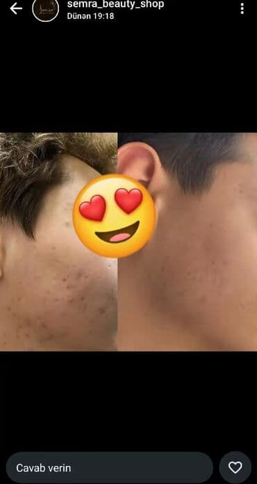 таблетки для похудения в баку: Saç üçün yağ, Saç tökülməsinə qarşı — 14