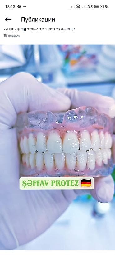 avtomobil yuma: İndi Daha Rahat və Estetik 💠 Qiymətlər Estetik plomb (1 diş) – 50₼ — 2