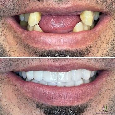 акция на установку брекетов: Stomatoloji xidmetler tam steril ve muasir. dislerin plomblanmasi — 6