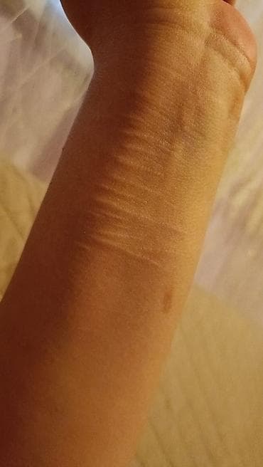 eclat sport perfume: Çapıqların lazer vasitəsilə yox edilməsi — 1