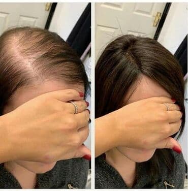 для похудения новая: Saç tökülməsinin kökündən həlli. Həm daxildən qida əlavələri qəbul — 2