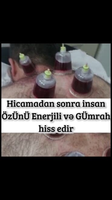 ağ dırnaq modelleri: Hicamanın Faydaları✅ *Qan dövranın pozulması *Qanın təmizlənməsi — 3