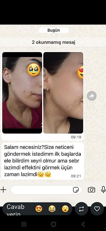 Sızanaq və ləkələrə qarşı effektiv dəriyə qulluq proqramı - Üz