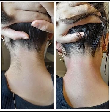 telebelere iş: Lazer Epilyasiya Xidməti – Candela Alexandrite ilə - Peşəkar lazer — 6