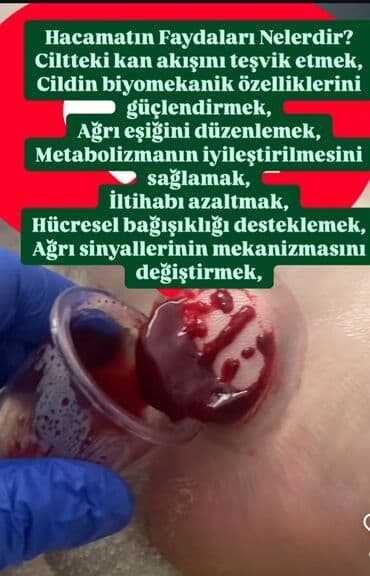 Hicama, bankoterapiya və zəli terapiyası xidməti Təklif olunan lalafo.az -da Hicama, bankoterapiya və zəli terapiyası xidməti Təklif olunan