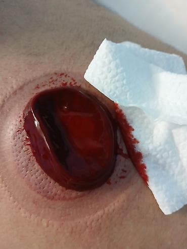 Xəstələrin ehtiyacına uyğun yaş və quru hacamat xidməti Təsvir: - lalafo.az -da Xəstələrin ehtiyacına uyğun yaş və quru hacamat xidməti Təsvir: -