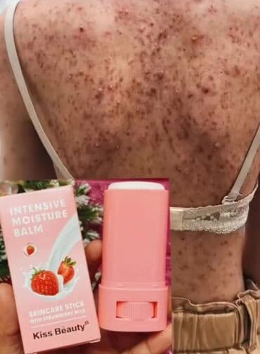 Gene sepki eleyhine stik lalafo.az -da Gene sepki eleyhine stik