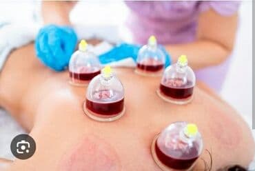 Xəmsə (hijama) – vakuum fincanlarla qan çıxarma terapiyası Xidmət lalafo.az -da Xəmsə (hijama) – vakuum fincanlarla qan çıxarma terapiyası Xidmət