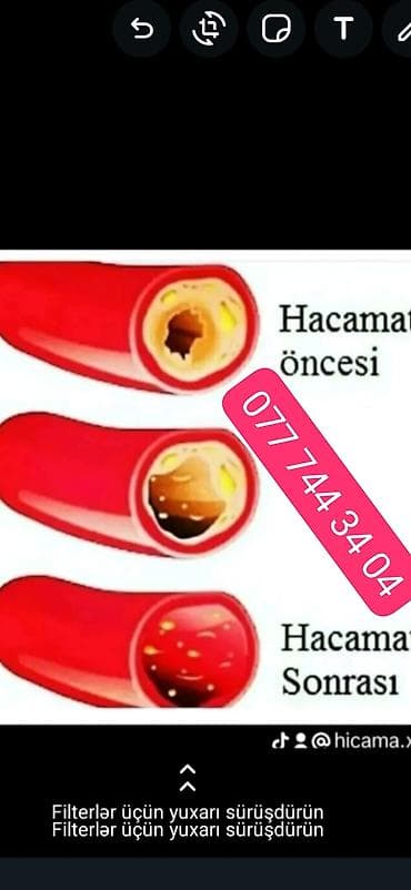 HİCAMA EDİRƏM 30 AZN bankalar 1 dəfəlikdir sonra atilir 1 seansa 7 lalafo.az -da HİCAMA EDİRƏM 30 AZN bankalar 1 dəfəlikdir sonra atilir 1 seansa 7