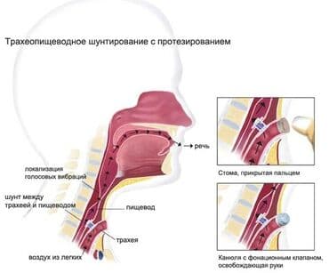 Trakeo‑özofageal şunt və səs berpasi. Girtlagi cixarilanlar insanlara lalafo.az -da Trakeo‑özofageal şunt və səs berpasi. Girtlagi cixarilanlar insanlara