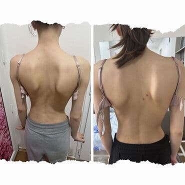 Xidmət: Kupa terapiyası (quru və yaş/hicama), bel–boyun–çiyin masajı lalafo.az -da Xidmət: Kupa terapiyası (quru və yaş/hicama), bel–boyun–çiyin masajı