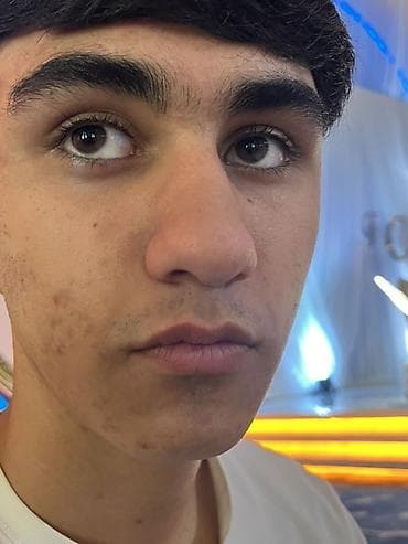 Üz qulluğu xidməti – sızanaq və piqment ləkələrinin azaldılması üçün lalafo.az -da Üz qulluğu xidməti – sızanaq və piqment ləkələrinin azaldılması üçün