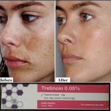 Üz kremi, Akneyə meyilli dəri üçün, 15 ml, Yeni, Pulsuz çatdırılma lalafo.az -da Üz kremi, Akneyə meyilli dəri üçün, 15 ml, Yeni, Pulsuz çatdırılma